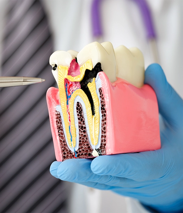 Tooth Needing A Root Canal